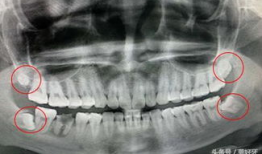 拔智齿视频全真实过程,拔智齿的真实手术过程